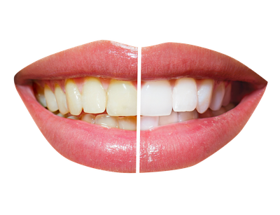 Teeth Whitening PNG Transparent Image