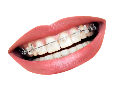 Teeth With Braces PNG Transparent Image