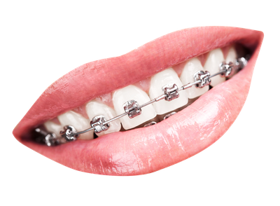 Teeth With Braces PNG Transparent Image